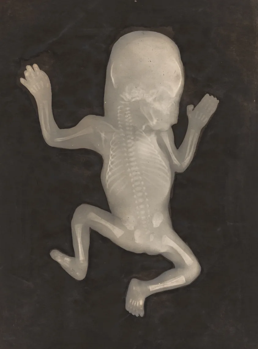 Degree of Ossification of a Five-Month-Old Fetus (Degré d'ossification d'un Foetus de cinq mois)